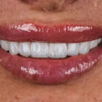 Technique​‍​‌‍​‍‌​‍​‌‍​‍‌ Hollywood Smile 3D: How is Hollywood Smile Done?