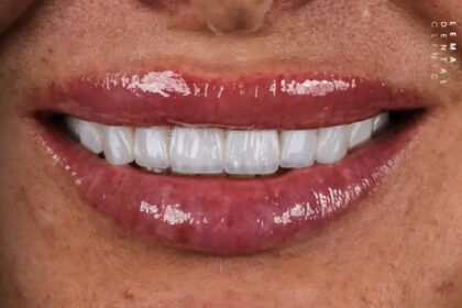 Technique​‍​‌‍​‍‌​‍​‌‍​‍‌ Hollywood Smile 3D: How is Hollywood Smile Done?